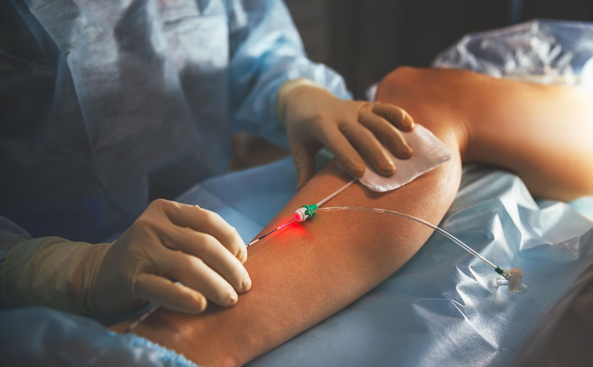 Miami Varicose Veins Treatment